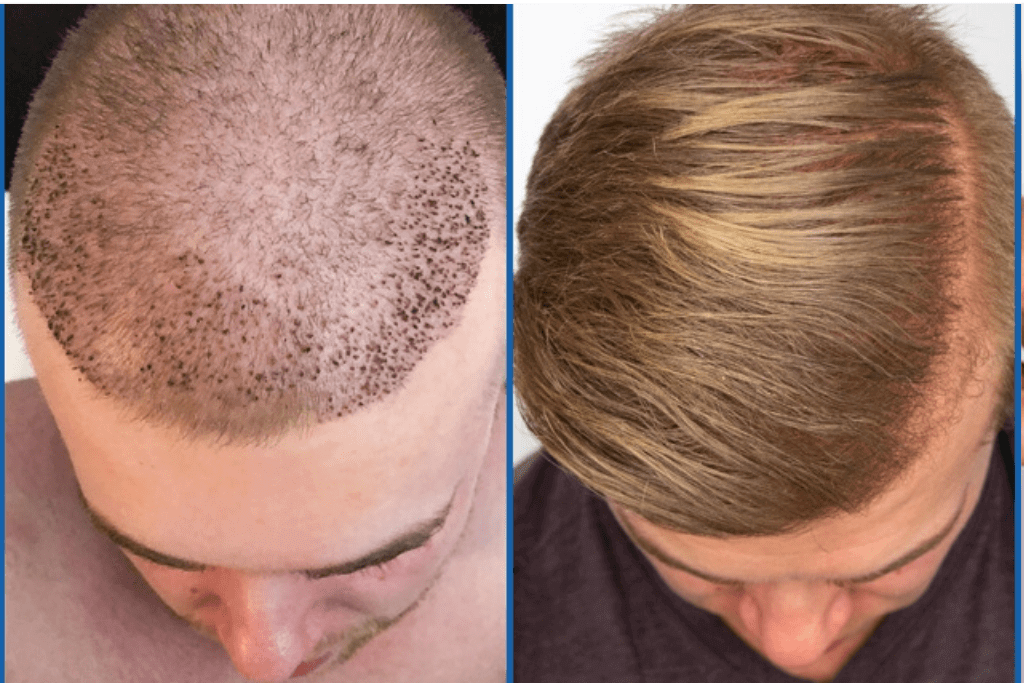 erste Woche nach der Haartransplantation