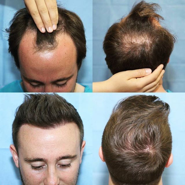 Trasplante de cabello de frente y parte superior de la cabeza antes después