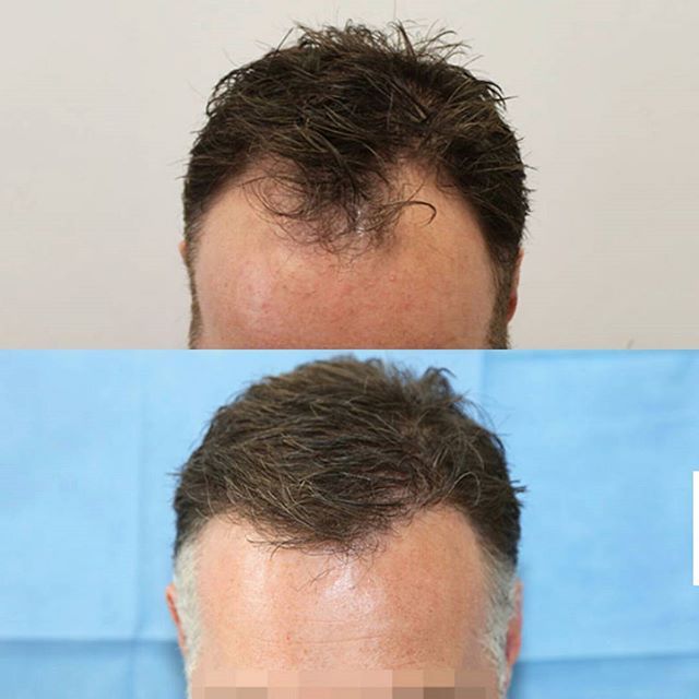 forehead hair transplant before after