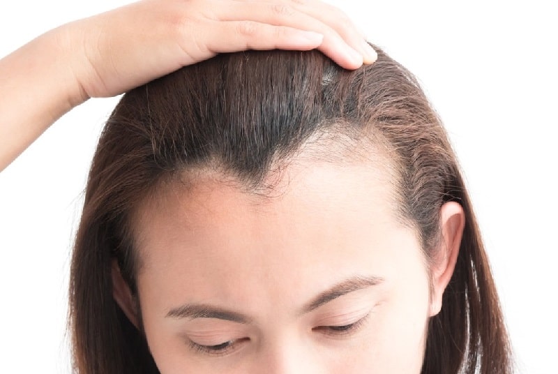 forehead hair transplant