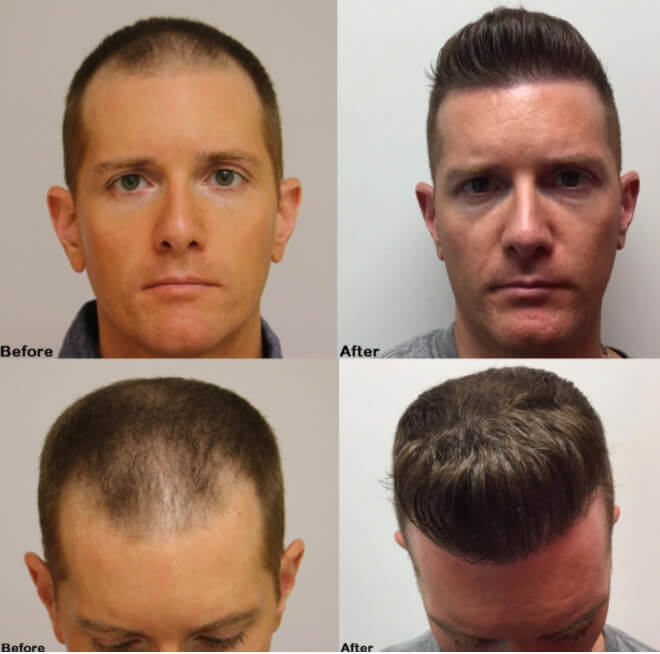 Stirn Männer Haartransplantation vorher nachher