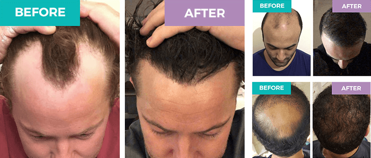 fue trasplante de cabello antes después