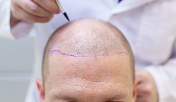 Ergebnisse der FUE-Haartransplantation