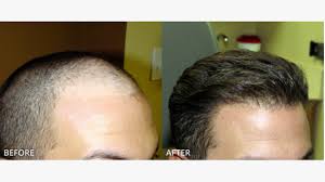 Ejemplos de antes y después de trasplante de cabello FUE