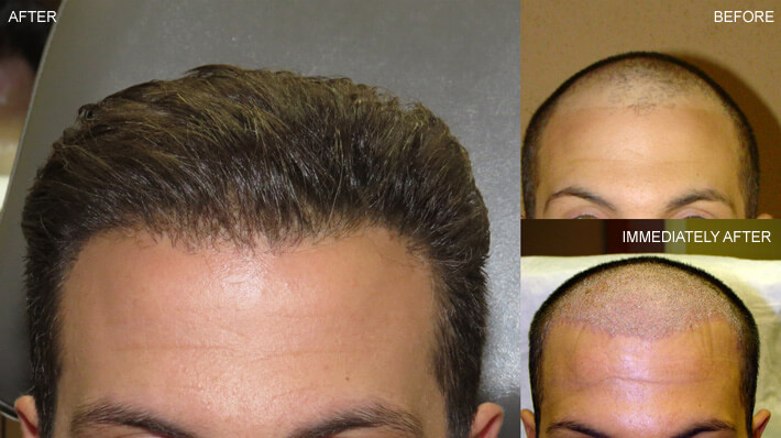 FUE hair transplantation before after