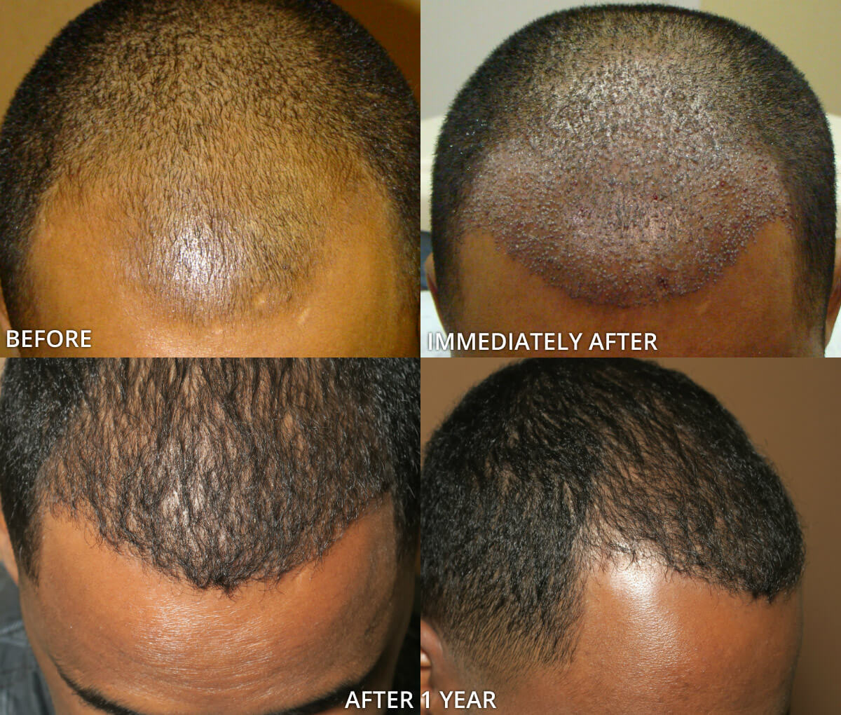 after FUE hair transplant result