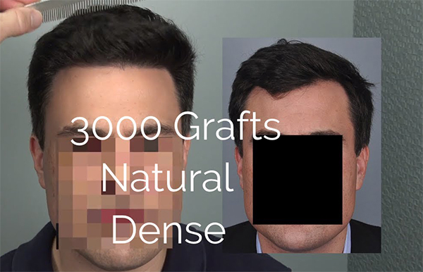 FUE hair transplant