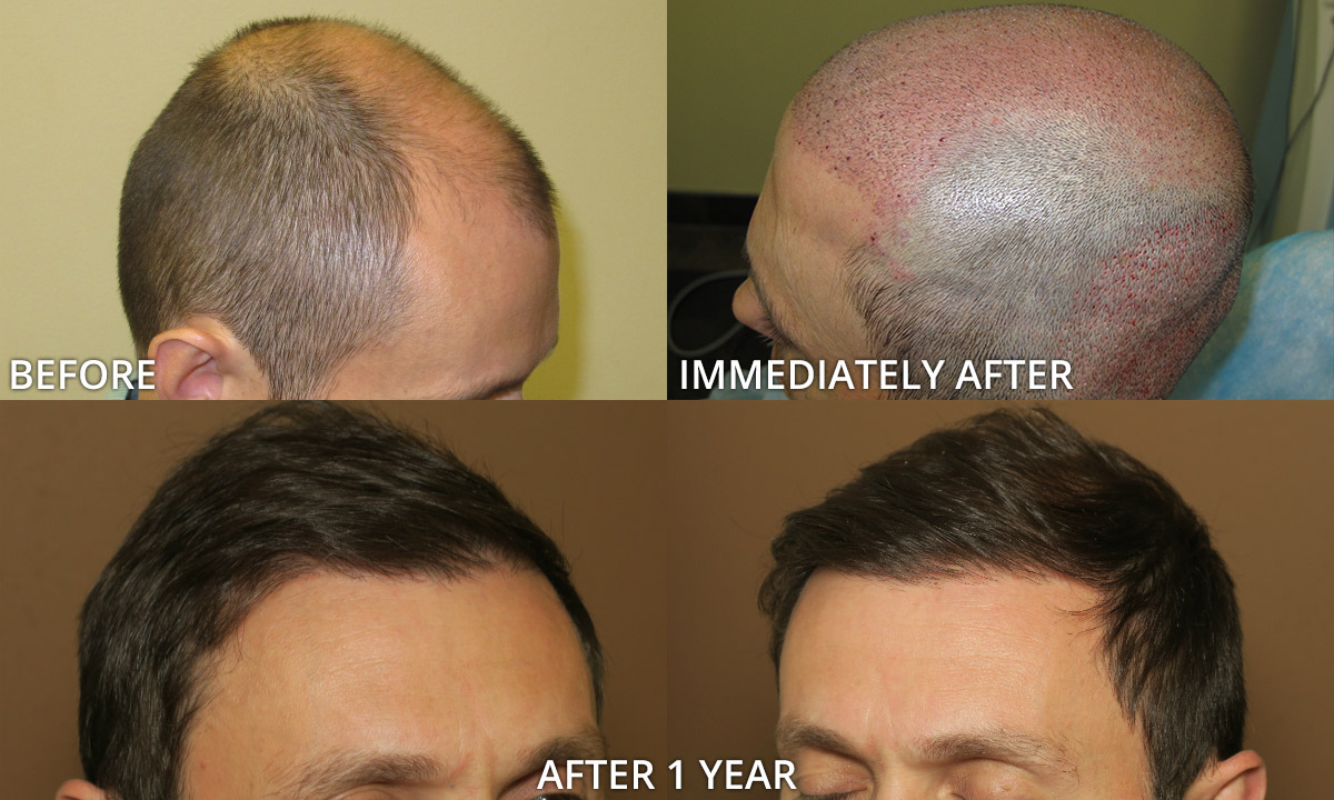 Fue Haartransplantation vor nach Fotos