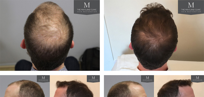 Fut Haartransplantation vor nach Preisen