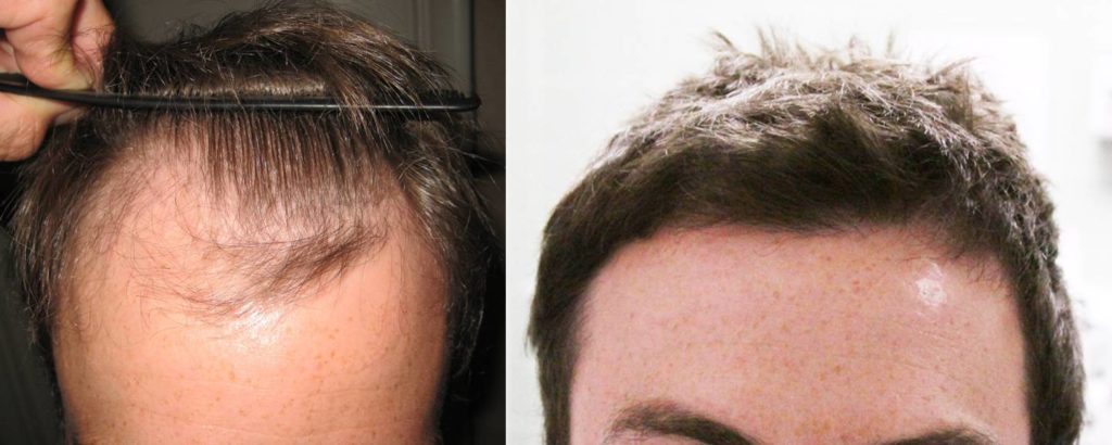 fut hair transplant before after