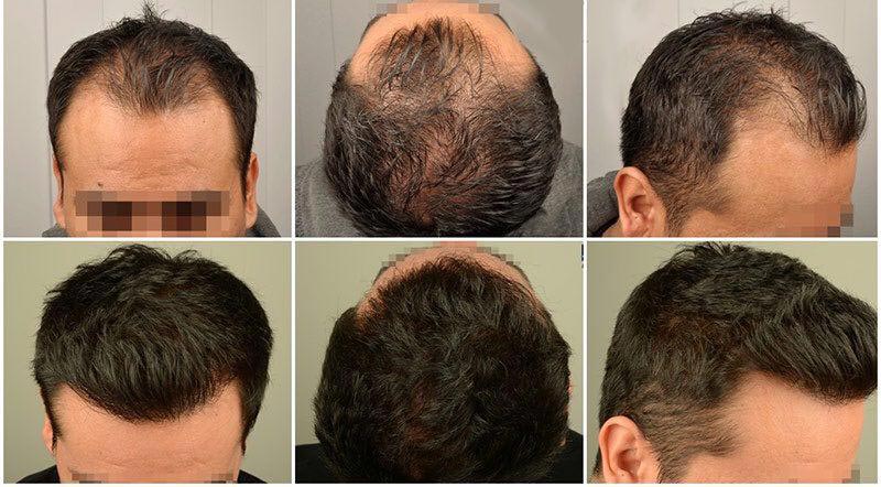 Ergebnisse der FUT-Haartransplantation