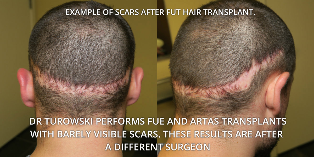 fut hair transplant scar