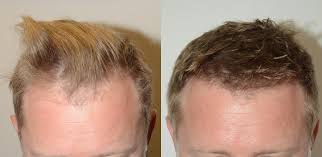 FUT hair transplantation before after