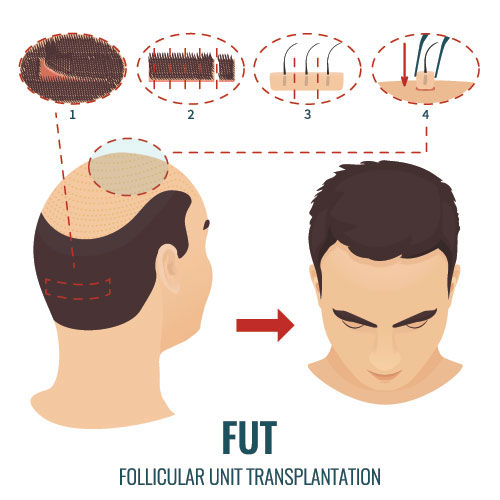 FUT hair transplant