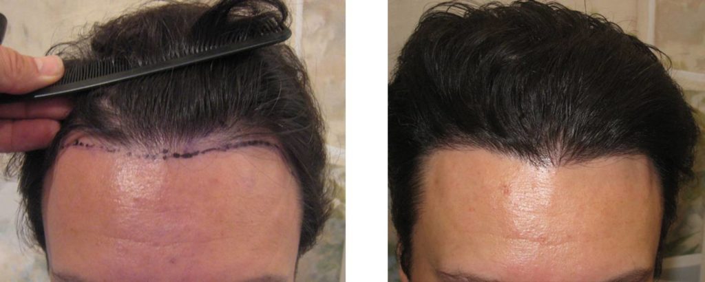 Fut Haartransplantation Ergebnis