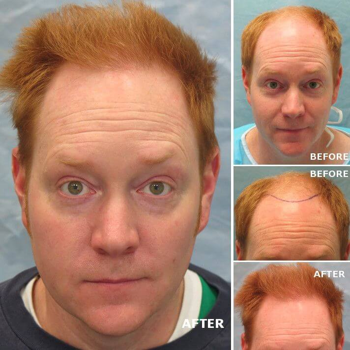 ginger hair color hair transplant before after