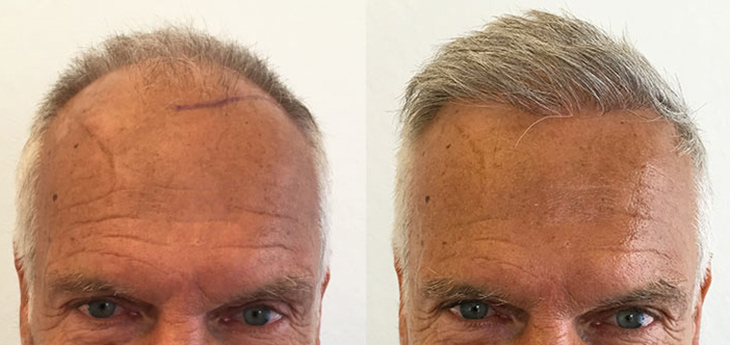 grey hair transplant