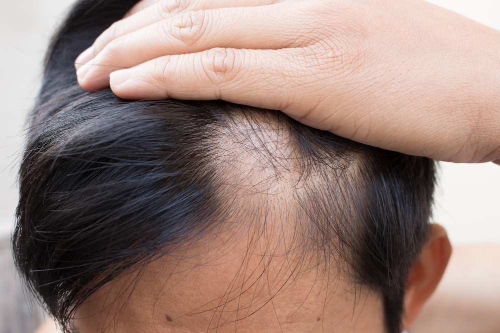 hair loss causes