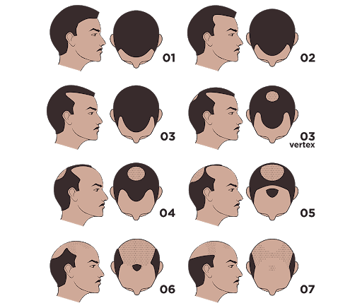 stades de perte de cheveux avec échelle de norwood