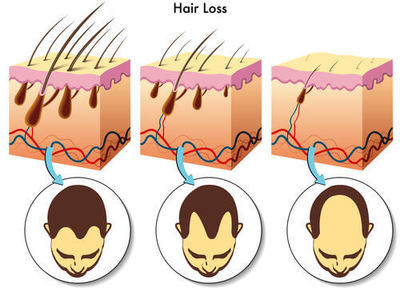 tipos de pérdida de cabello