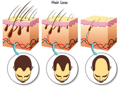 hair loss types