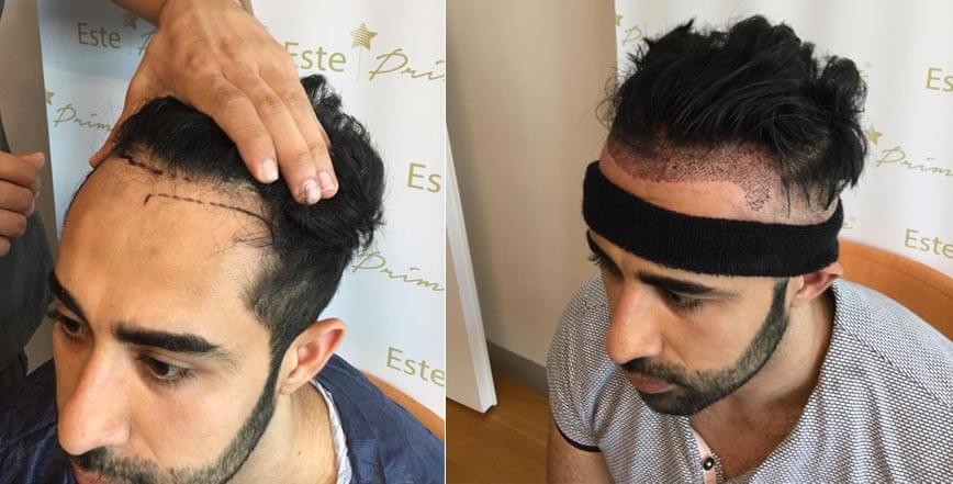 Precauciones para el cuidado posterior del trasplante de cabello