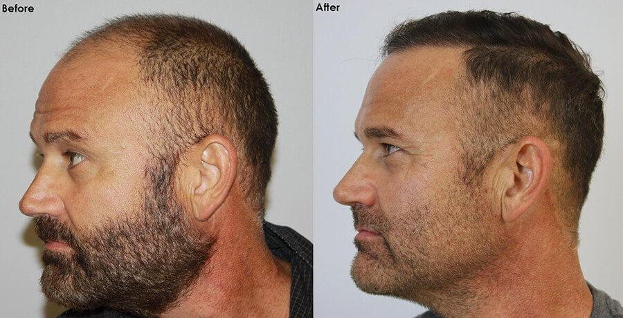 hair transplant before after photo