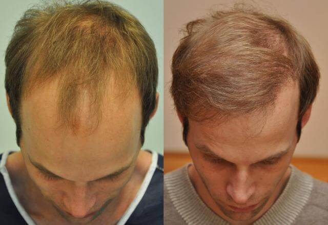 Haartransplantation vor nach der Türkei