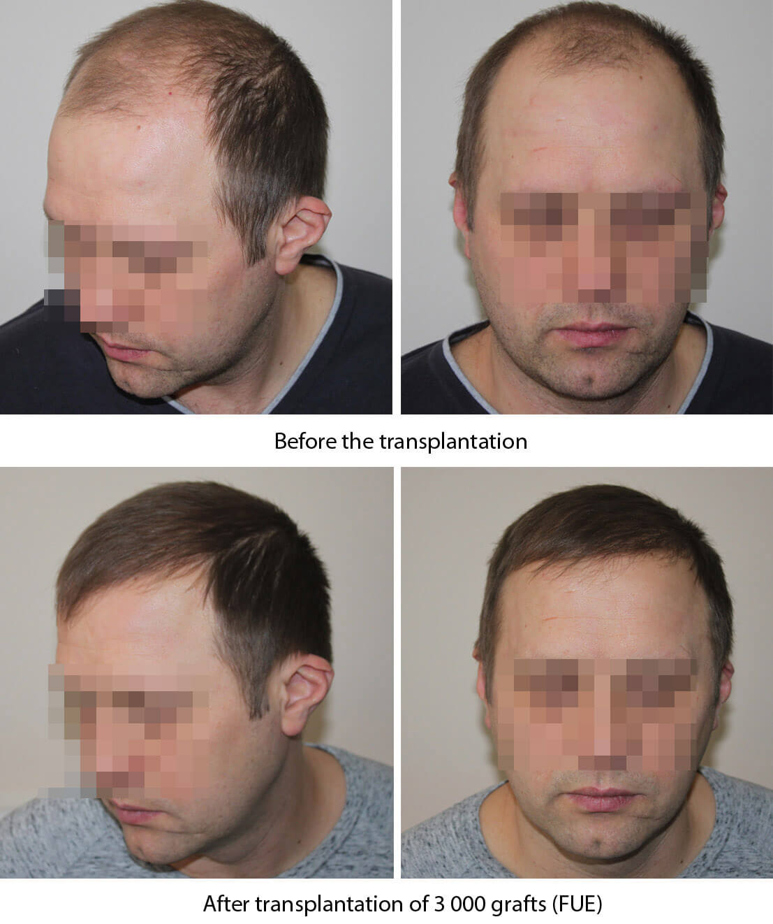 Haartransplantation vorher nachher