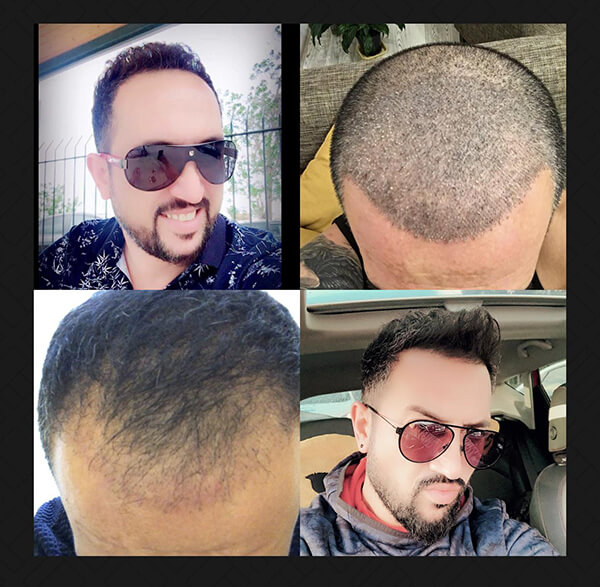 hair transplant before after natural example