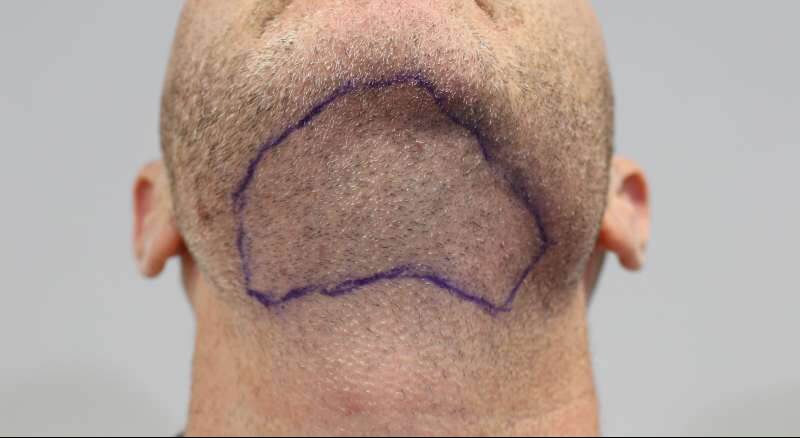 Haartransplantation vom Bart