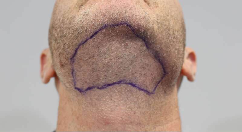 hair transplant from beard