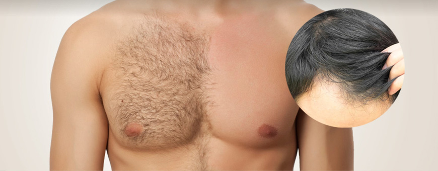 greffe de cheveux du pubis