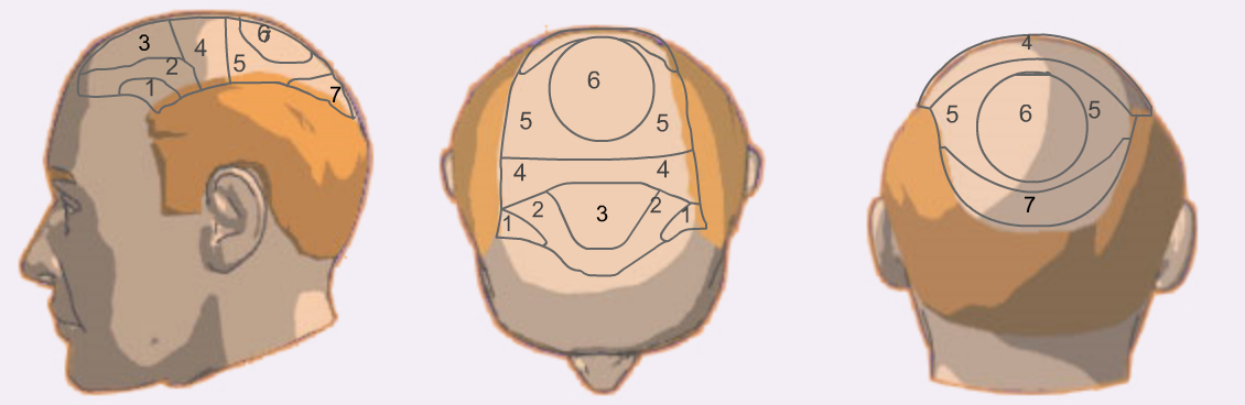 hair transplant online graft calculation