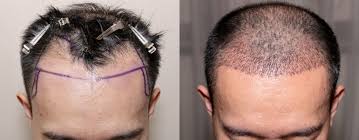 Haartransplantation Haaransatz_2