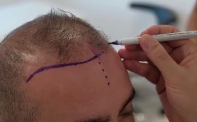 Haartransplantation Haaransatz