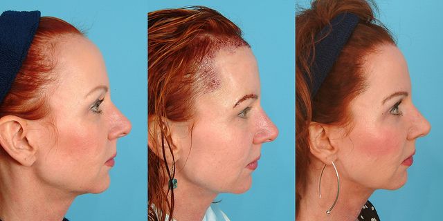 Haartransplantation in der Stirn