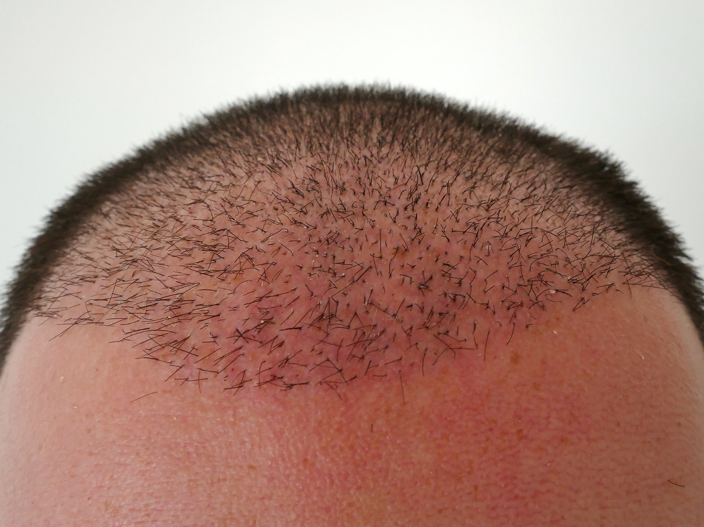 hair transplant shock hair loss
