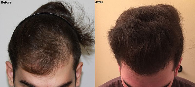 hair transplant with prp treatment