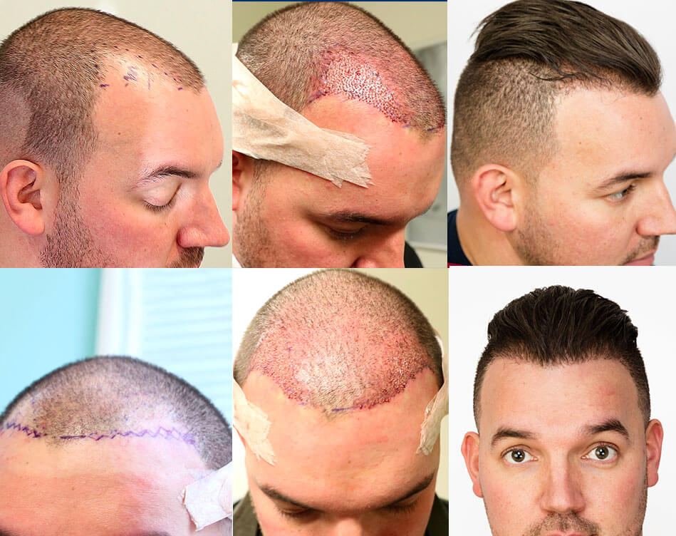 hair transplant_3