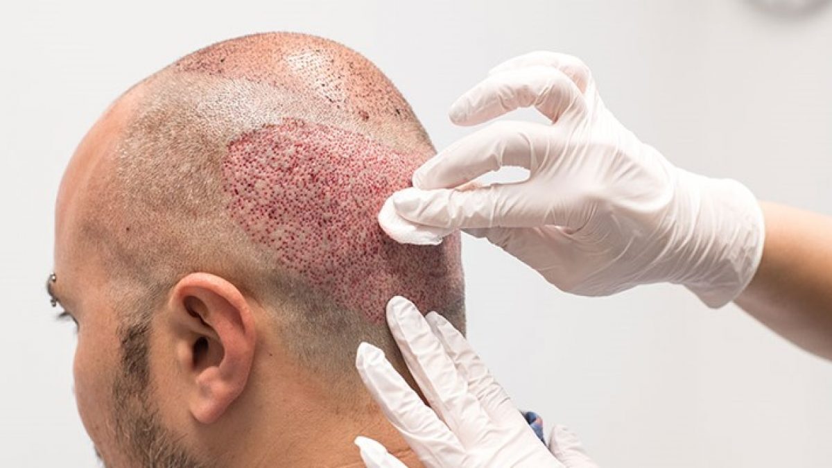 lavado de cabello después del trasplante de cabello