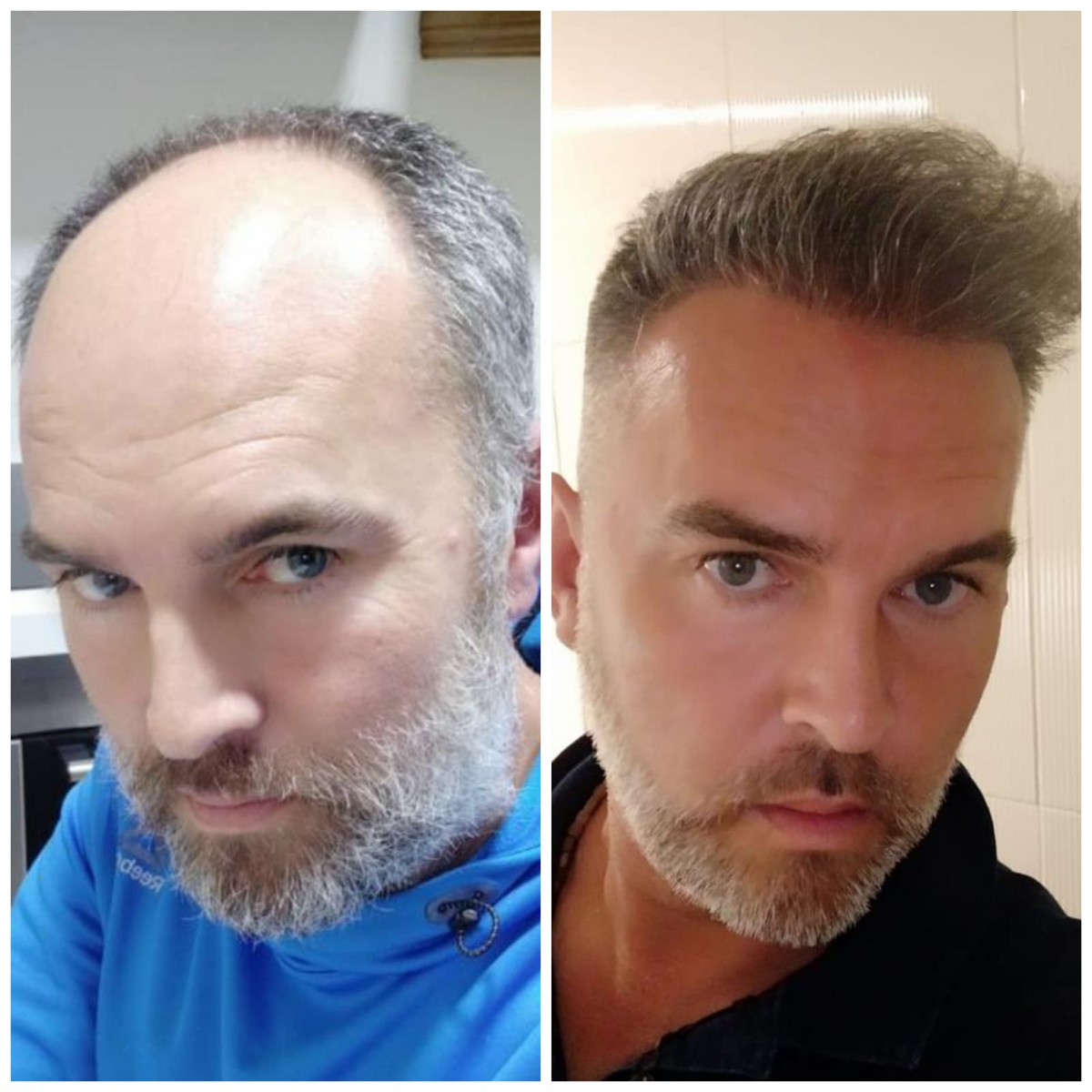 trasplante de cabello antes y después fotos