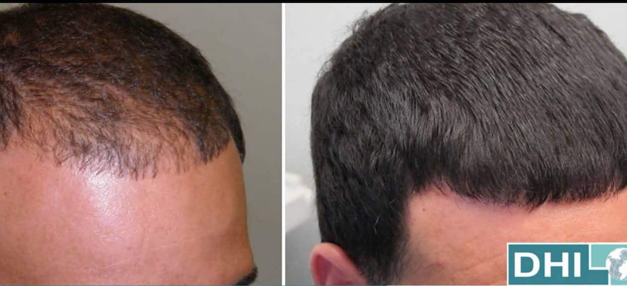 ¿Cómo se realiza el trasplante de cabello DHI?