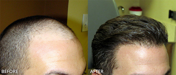 How is FUE HairTransplant performed