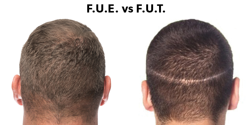 ¿Cómo se realiza el trasplante de cabello FUT?