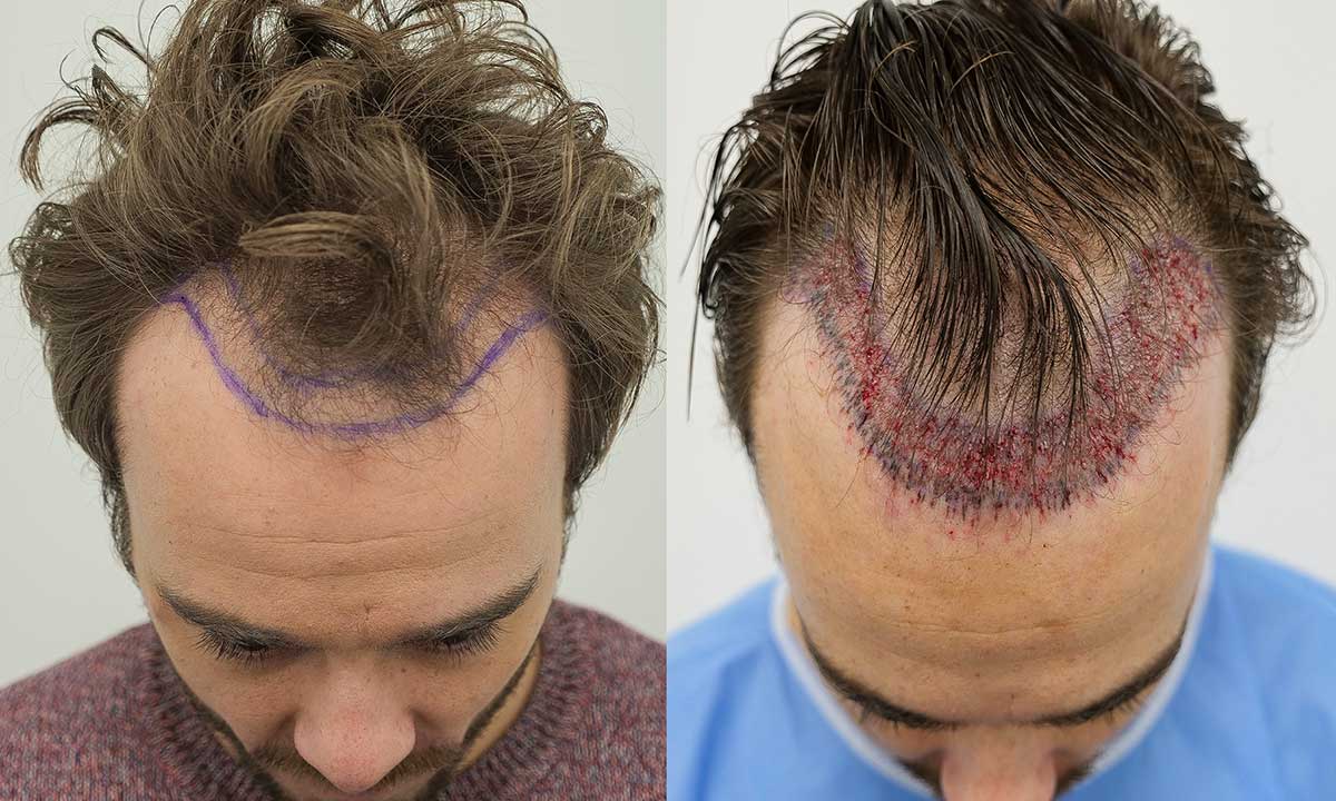 how long to avoid exercise afterhair transplant