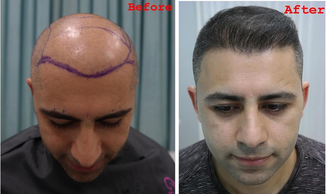 how to perform a natural hair transplant_7