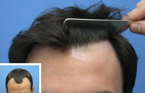 how to perform a natural hair transplant