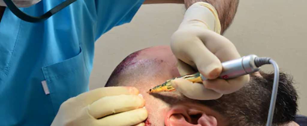 How is Micromotor hair transplant performed