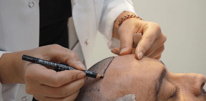 Ergebnisse einer hyperbaren Haartransplantation